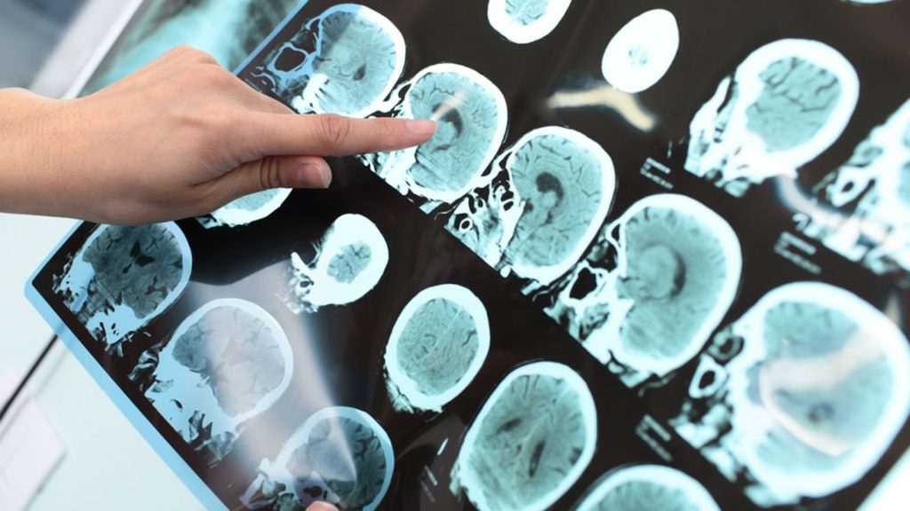 Entenda o que é a Doença de Alzheimer - Supera - Estimulação Cognitiva
